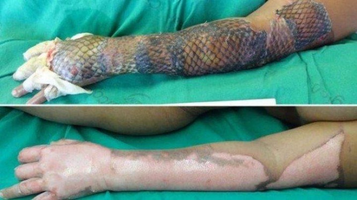 5 Fakta Mengejutkan Kulit Ikan Nila, Luka Bakar Langsung Sembuh