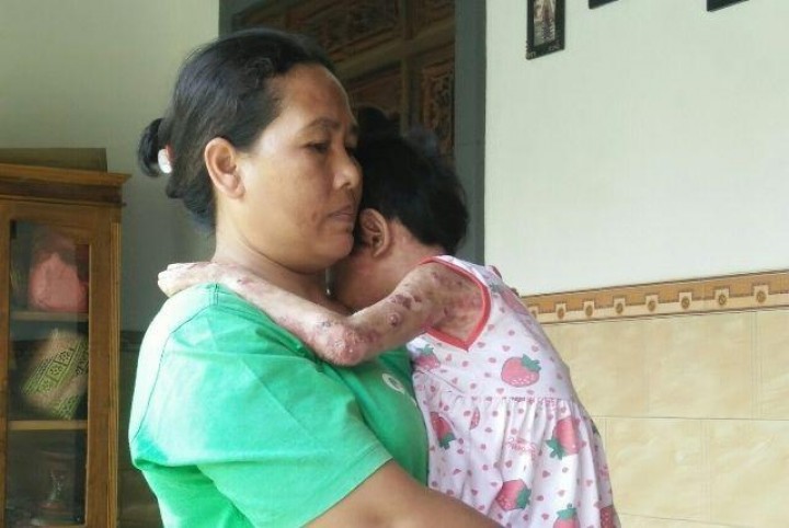 Akibat Pernikahan Sedarah, Sekujur Tubuh Anak Mengelupas