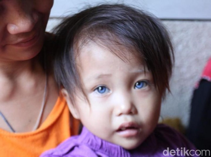 Unik! Anak Balita di Bandung Miliki Bola Mata Tiga Warna