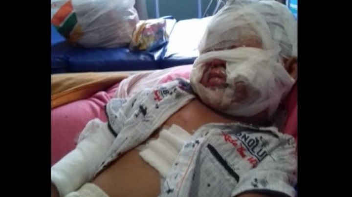 Ya Allah! Sekujur Badan Bayi Terbakar, Api Tersulut dari Hand Sanitizer