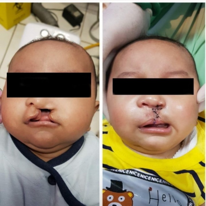 Kenali Penyebab & Penanganan Bibir Sumbing